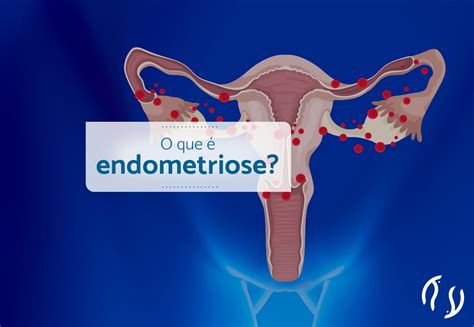 o que causa endometriose - o mascara